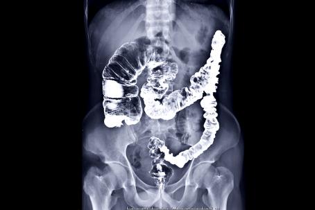 X-ray image of the colon obtained using a contrast medium that strongly attenuates X-rays. (Source: © samunella / stock.adobe.com)