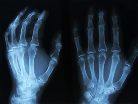 X-ray image of a patient's left hand. X-rays make it possible to visualise internal structures, particularly bones, without invasive examination. (Source: © Tsiumpa / stock.adobe.com)